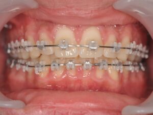 Orthodontie Suresnes - Dr Nadia Kebaili - Bagues ceramiques - 2