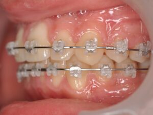 Orthodontie Suresnes - Dr Nadia Kebaili - Bagues ceramiques - 4