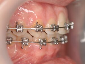 Orthodontie Suresnes - Dr Nadia Kebaili - Bagues metaliques - 2