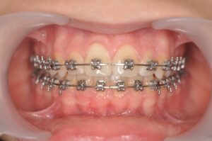 Orthodontie Suresnes - Dr Nadia Kebaili - Bagues metaliques - 3