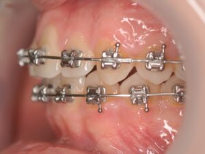 Orthodontie Suresnes - Dr Nadia Kebaili - Bagues metaliques - 4