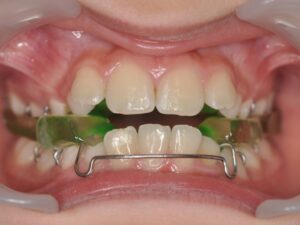 Orthodontie Suresnes - Dr Nadia Kebaili - orthodontie interceptive - 1
