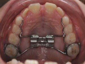 Orthodontie Suresnes - Dr Nadia Kebaili - orthodontie interceptive - 2