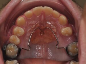 Orthodontie Suresnes - Dr Nadia Kebaili - orthodontie interceptive - 5