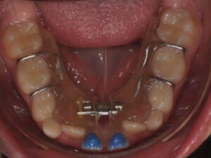 Orthodontie Suresnes - Dr Nadia Kebaili - orthodontie interceptive - 6