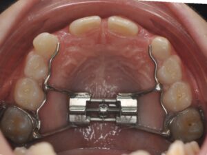 Orthodontie Suresnes - Dr Nadia Kebaili - orthodontie interceptive - 8