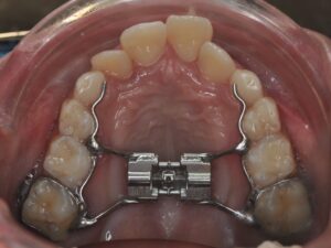 Orthodontie Suresnes - Dr Nadia Kebaili - orthodontie interceptive - 9