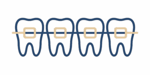 orthodontie-classique---orthodontie-suresnes