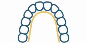 orthodontie-contention-passive---orthodontie-suresnes-2