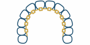 orthodontie-invisible---orthodontie-suresnes