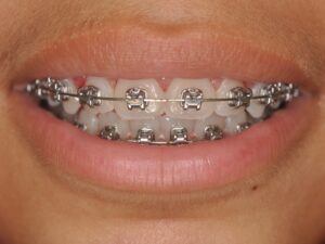 Dr Nadia Kebaili - Suresnes - othodontie classique - 1