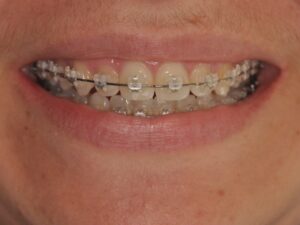 Dr Nadia Kebaili - Suresnes - othodontie classique - 10