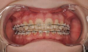 Dr Nadia Kebaili - Suresnes - othodontie classique - 2