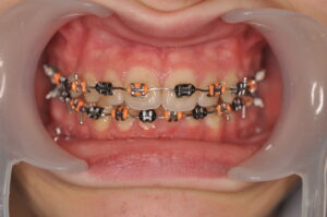 Dr Nadia Kebaili - Suresnes - othodontie classique - 3