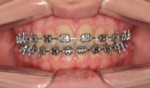 Dr Nadia Kebaili - Suresnes - othodontie classique - 4