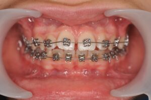 Dr Nadia Kebaili - Suresnes - othodontie classique - 5