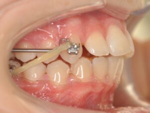 Dr Nadia Kebaili - Suresnes - othodontie classique - 6