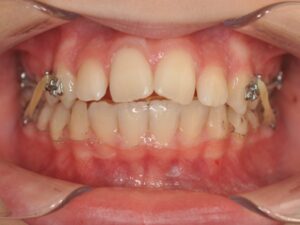 Dr Nadia Kebaili - Suresnes - othodontie classique - 7