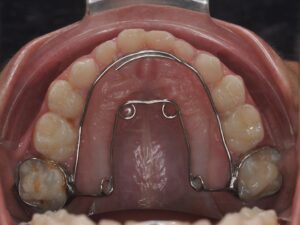 Dr Nadia Kebaili - Suresnes - othodontie esthetique - 1