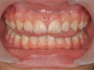 Dr Nadia Kebaili - Suresnes - othodontie esthetique - 1