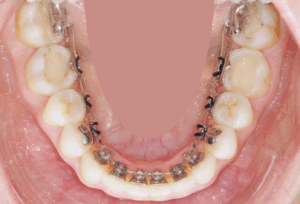 Dr Nadia Kebaili - Suresnes - othodontie esthetique - 1