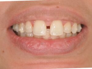 Dr Nadia Kebaili - Suresnes - othodontie esthetique - 1