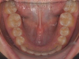 Dr Nadia Kebaili - Suresnes - othodontie esthetique - 10