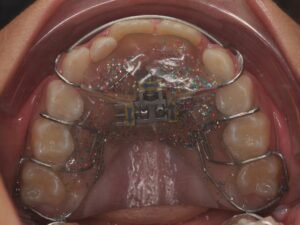 Dr Nadia Kebaili - Suresnes - othodontie esthetique - 2