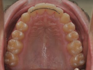 Dr Nadia Kebaili - Suresnes - othodontie esthetique - 2