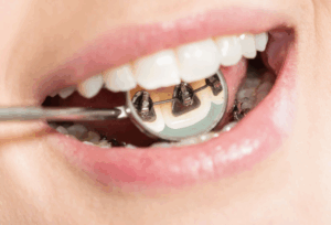 Dr Nadia Kebaili - Suresnes - othodontie esthetique - 2