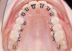 Dr Nadia Kebaili - Suresnes - othodontie esthetique - 3