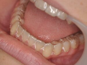 Dr Nadia Kebaili - Suresnes - othodontie esthetique - 3