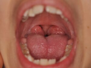 Dr Nadia Kebaili - Suresnes - othodontie esthetique - 3