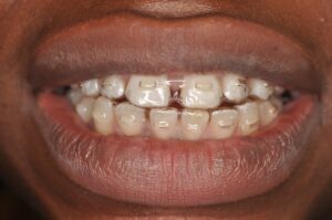 Dr Nadia Kebaili - Suresnes - othodontie esthetique - 3