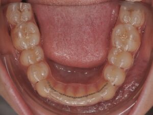 Dr Nadia Kebaili - Suresnes - othodontie esthetique - 4