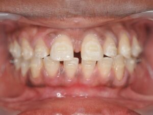 Dr Nadia Kebaili - Suresnes - othodontie esthetique - 4