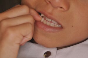 Dr Nadia Kebaili - Suresnes - othodontie esthetique - 5