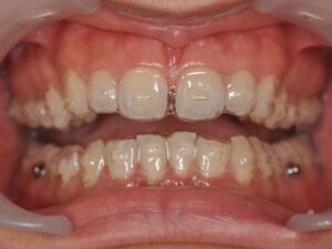 Dr Nadia Kebaili - Suresnes - othodontie esthetique - 5