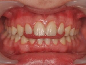 Dr Nadia Kebaili - Suresnes - othodontie esthetique - 6