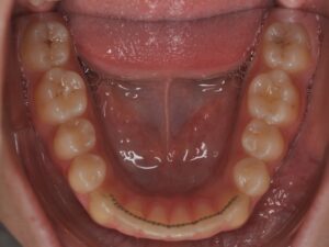 Dr Nadia Kebaili - Suresnes - othodontie esthetique - 6