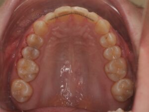 Dr Nadia Kebaili - Suresnes - othodontie esthetique - 7